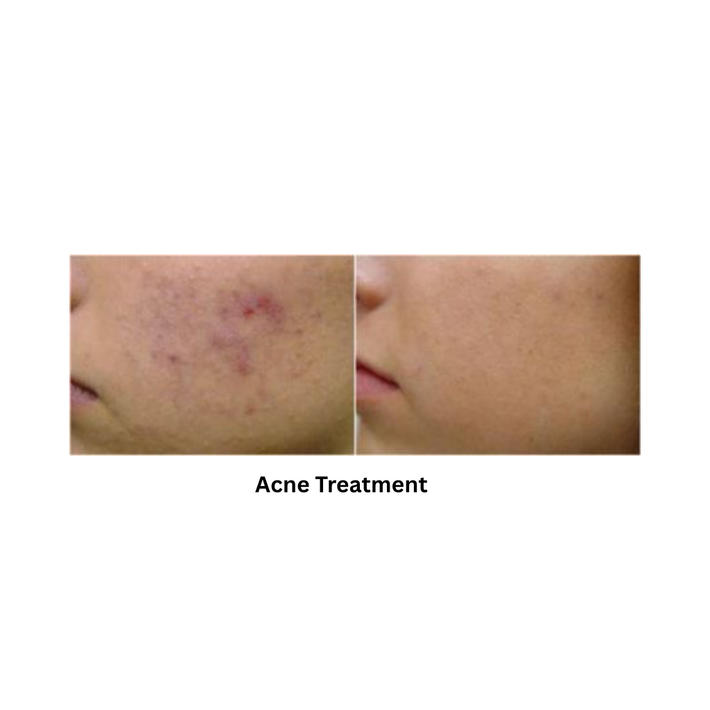 Extra 818 Hair Removal & Facial Treatment System - Image 3
