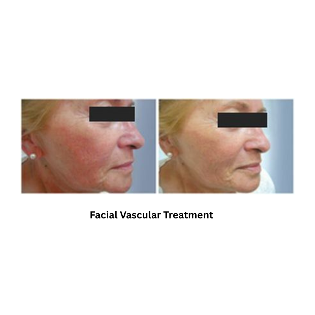 Extra 818 Hair Removal & Facial Treatment System - Image 6