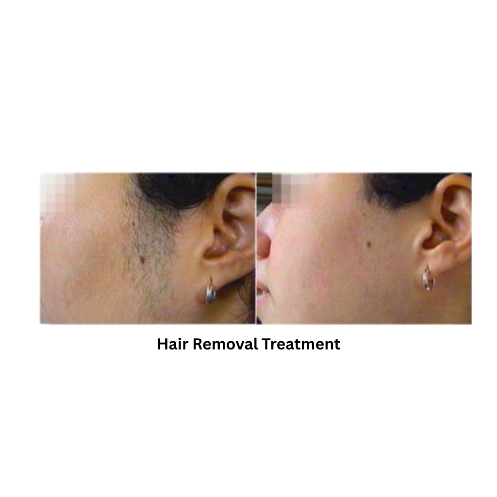 Extra 818 Hair Removal & Facial Treatment System - Image 4