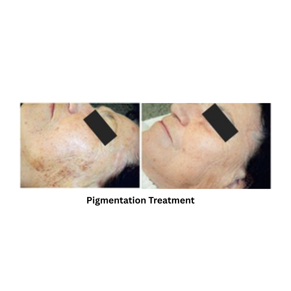 Extra 818 Hair Removal & Facial Treatment System - Image 5
